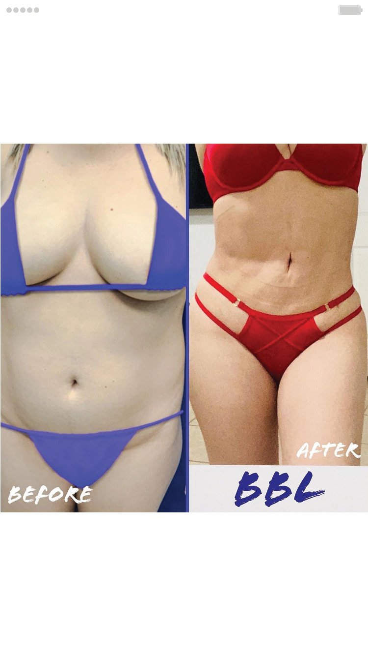 Cirugía de Levantamiento de glúteos (BBL)