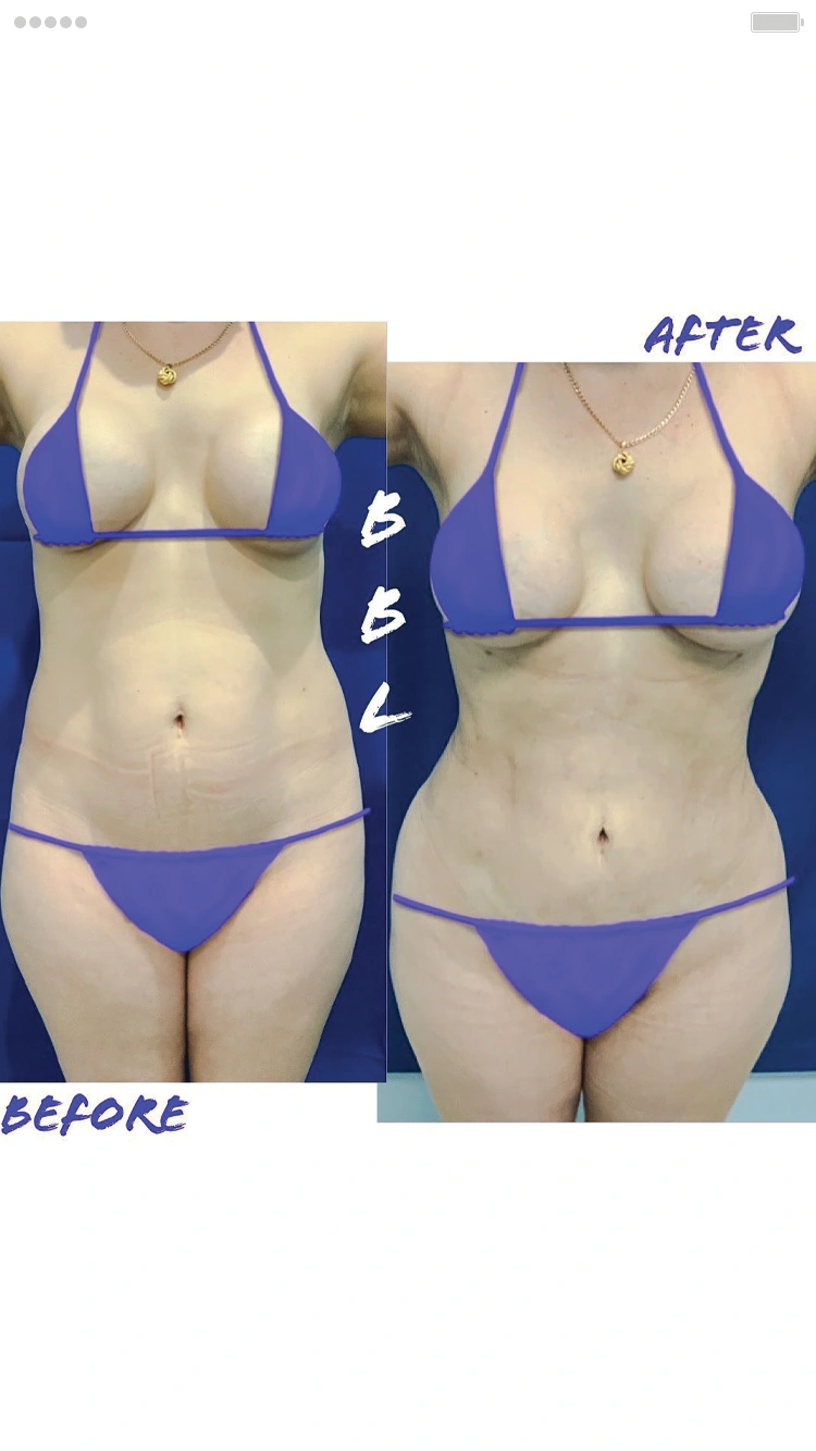 Cirugía de Levantamiento de glúteos (BBL)