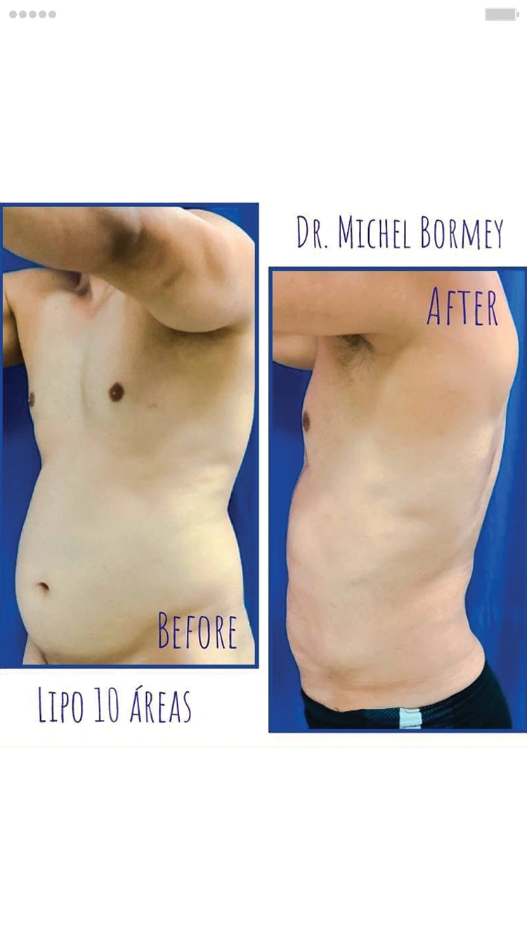 Cirugía de Liposucción