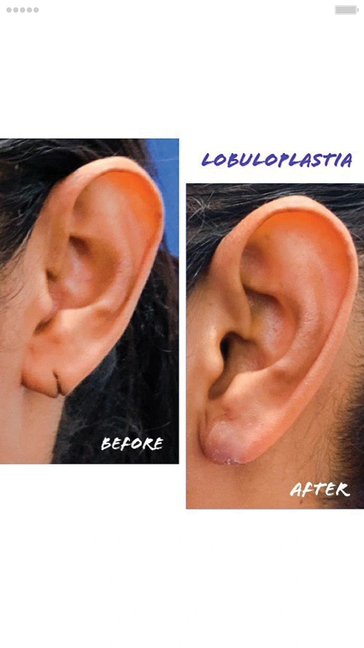 Cirugía de Lobuloplastia