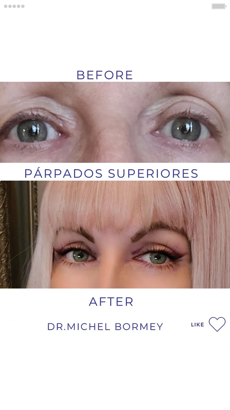 Cirugía de Párpados Superiores