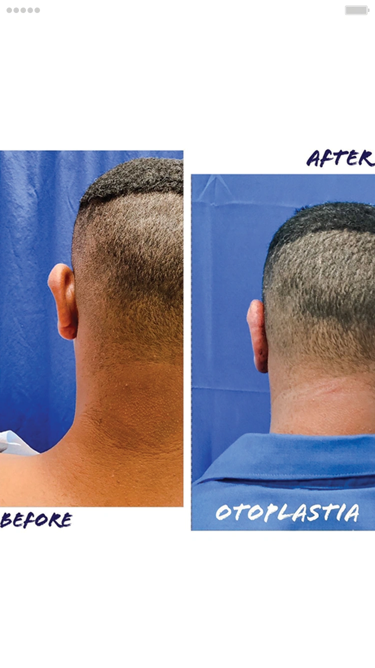 Cirugía de Otoplastia